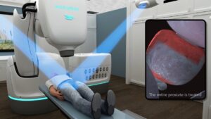 CyberKnife for Prostate Cancer Treatment